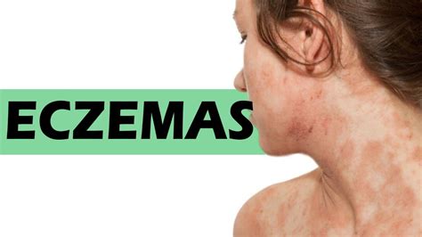 Como Curar Um Eczema Em Três Dias